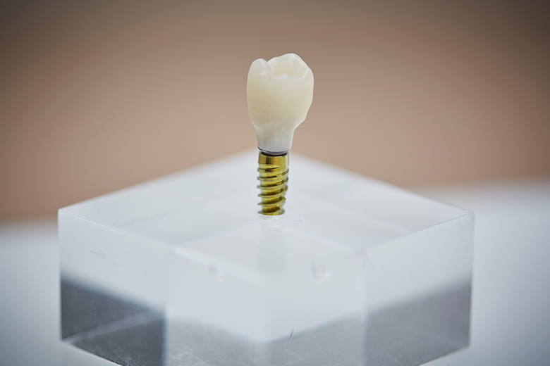 Implantate und feste Zähne